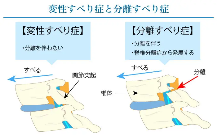 腰椎すべり症は自然に良くなる？保存療法の考え方｜小牧市